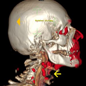Hypopharynxkarzinom mit LK-Metastasen Fremdkörpergefuehl FDG-PET/CT