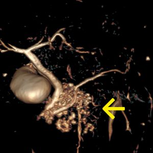 IPMN Intraduktale papillär-muzinöse Neoplasie Processus uncinatus MRCP-VR