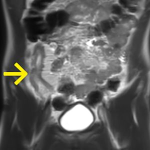 Ileitis terminalis Crohn MRT-T2W-cor Ileitis terminalis Crohn MRT-T2W-cor