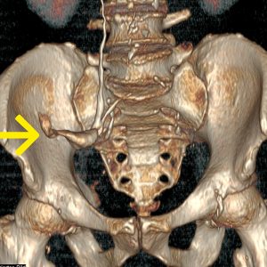 Ileumconduit nach HarnblasenCa CT-Urographie Ileumconduit nach HarnblasenCa CT-Urographie