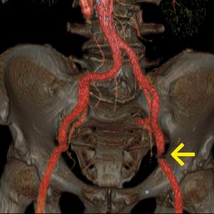 Iliakalarterienstenose links Fontaine II CT-Angio