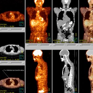 Infizierter Katheterspitzenthrombus FDG-PET/CT