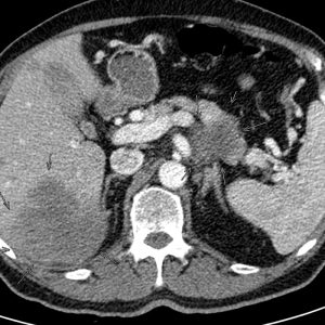 Inoperabler Bauchspeicheldrüsenkrebs mit Lebermetastasen axiale-CT mit KM