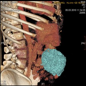 Intraabdominelles Desmoid CT-VR