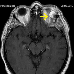 Intraorbitales Dermoid Doppelbilder MRT-T1W mit KM Intraorbitales Dermoid Doppelbilder MRT-T1W mit KM