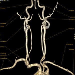 KM-gestuetzte-MR-Angiographie-extrakranielle-hirnversorgende-Arterien