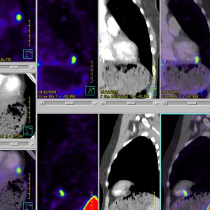 Karzinoid der Lunge vor 39J Perikardmetastase Ga68-DOTATOC-PET_CT