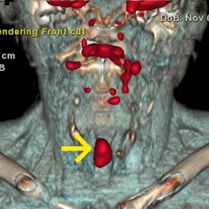 Kehlkopfkrebs FDG-PET/CT Kehlkopfkrebs FDG-PET/CT
