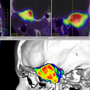 Keilbeinmeningeom links Ga68-DOTATOC-PET/CT Keilbeinmeningeom links Ga68-DOTATOC-PET/CT