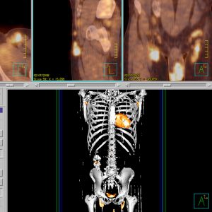 LK Konglomerate bei Neurodermitis CEA Erhoehung FDG-PET/CT