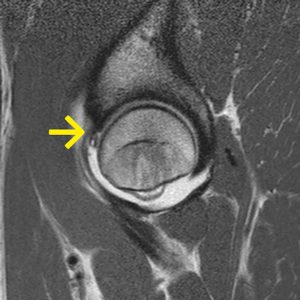 Labrumläsion Hüfte direkte MRT-Arthrographie