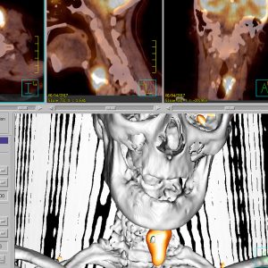 Larynxkarzinom Kehlkopfkrebs FDG-PET/CT Larynxkarzinom Kehlkopfkrebs FDG-PET/CT