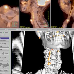 Larynxkarzinom Rezidiv FDG-PET/CT Larynxkarzinom Rezidiv FDG-PET/CT