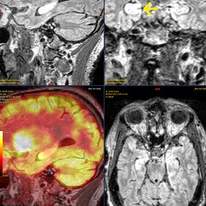 Limbische Encephalitis rechts FDG-PET MRT-Fusion