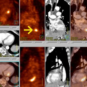 Lungenkrebs Myocardmetastase FDG-PET/CT