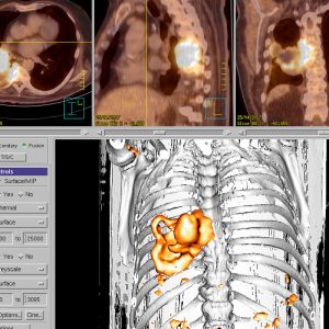 Lungenkrebs mit Wirbelsäuleninfiltration FDG-PET/CT