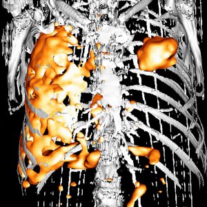 Lungenkrebs und Pleuramesotheliomv FDG-PET/CT