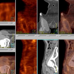 Lymphocele rechte Leiste FDG-PET/CT