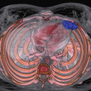 Lymphomrezidiv CT-VR