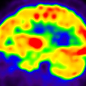 M. Alzheimer FDG-PET sagittal