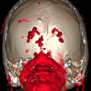M. Parkinson Lewy-Body-Disease F-DOPA PET/CT