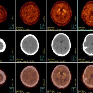 M. Parkinson nigrostriatale Degeneration F-DOPA PET/CT