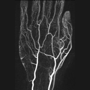 MR-Angiographie Hand mit KM o.B.