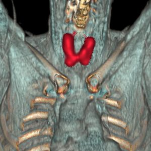 M. Basedow FDG-PET/CT-VR