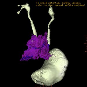 M. Ormond retroperitoneale Fibrose MRT-VR M. Ormond retroperitoneale Fibrose MRT-VR