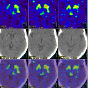 M. Parkinson F-DOPA PET/CT