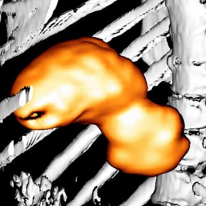 Magencarcinom FDG-PET/CT