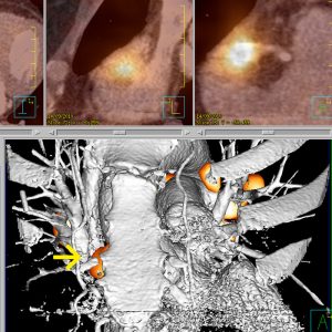 MammaCa Vorhofmeta FDG-PET-CardioCT16Zeiler