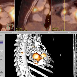 Mammakarzinom Vorhofmetastase FDG-PET/CT