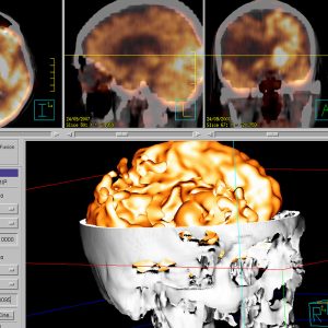 Mediainsult rechts FDG-PET/CT