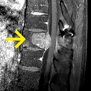 Merkelzelltumor BWK10-Infiltration MRT-sag-T1W mit KM