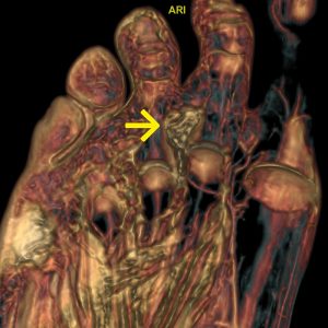 Morton Neurom MRT-mit-KM-VR