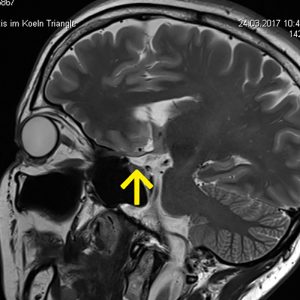 Multiple Sklerose Neuritis nevi optici MRT-parasag-T2W Multiple Sklerose Neuritis nevi optici MRT-parasag-T2W
