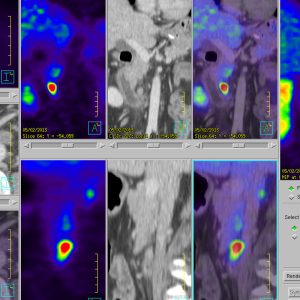 NET Neuroendokriner Tumor Gastrinom Zollinger Ellison Ga68-DOTATOC-PET/CT