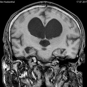 NPH Normaldruckhydrocephalus Verlangsamung kleinschrittiges Gangbild Inkontinenz MRT cor T1W