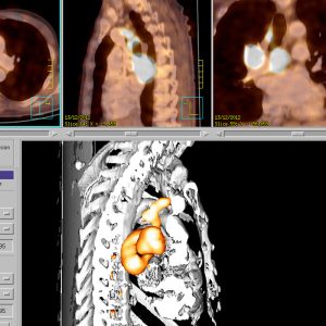 NSCLC AdenoCa re zentral FDG-PET/CT