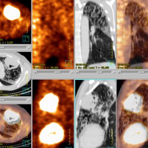 NSCLC Lymphangiosis FDG-PET/CT