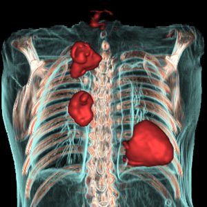 NSCLC und TBC VR