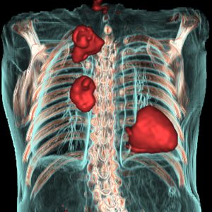 NSCLC und Tuberkulose FDG-PET/CT-VR