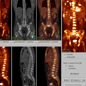 NSCLC rechter Oberlappen generalisierte ossäre Metastasen CEA 3110 FDG-PET/CT