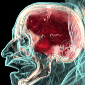 Nasopharynxkarzinom FDG-PET/CT