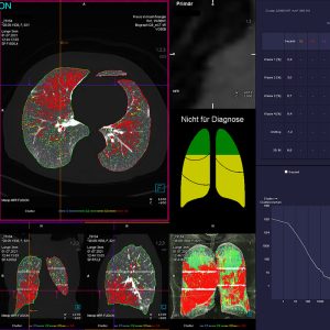 Niedrigdosis-CT Emphysemanalyse Raucherlunge