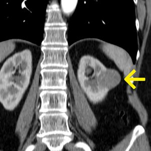 Nierenzellkarzinom bei MR LWS miterfasst CT-cor-MPR