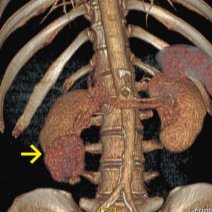 Nierenzellkarzinom rechts CT arterielle KM-Phase-VR