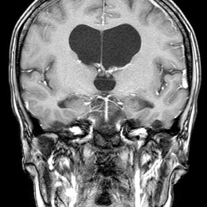 Normaldruckhydrocephalus kleinschrittiges Gangbild