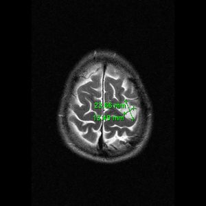 Oligoastrozytom Grad II links MRT-T2W-axial